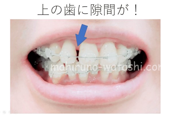 歯列矯正_上の歯に隙間