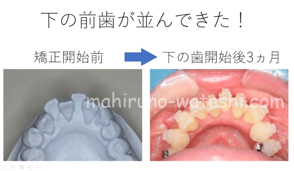 歯列矯正_下の前歯が並んできた